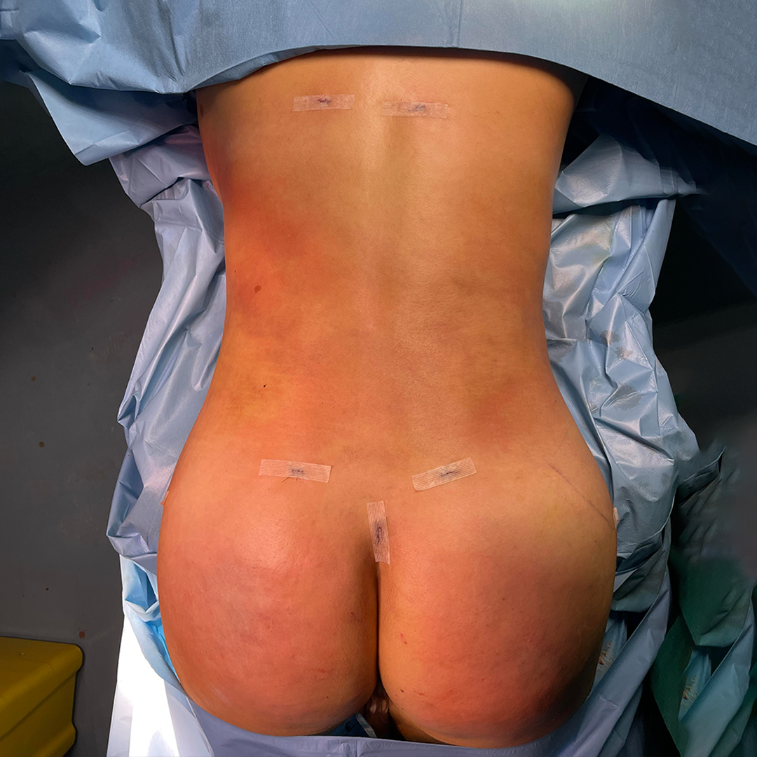 Estetica e Sorriso - Liposculpture After