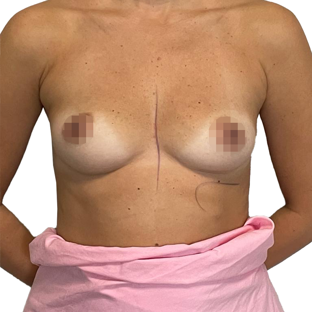 Estetica e Sorriso - Breast Augmentation