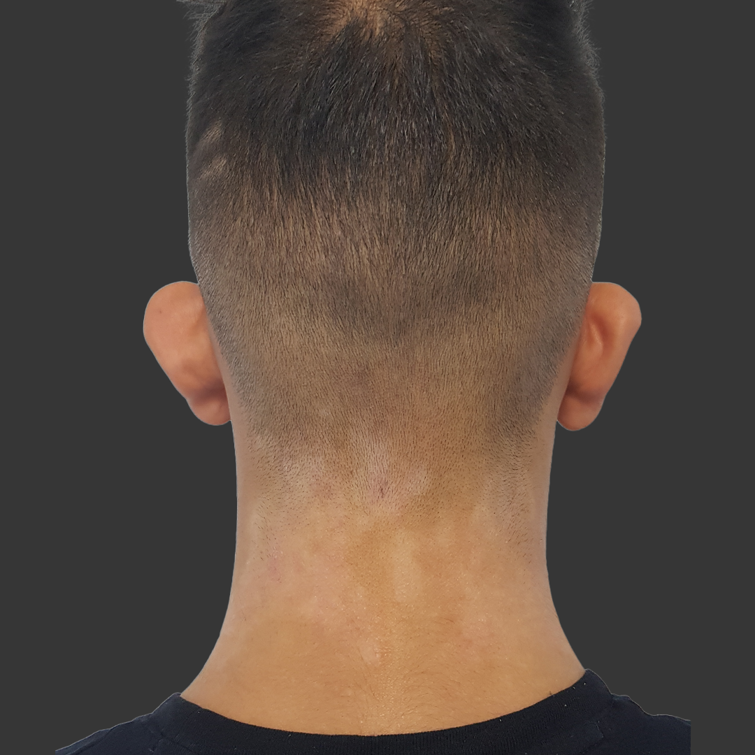 Estetica e Sorriso - Otoplasty Before