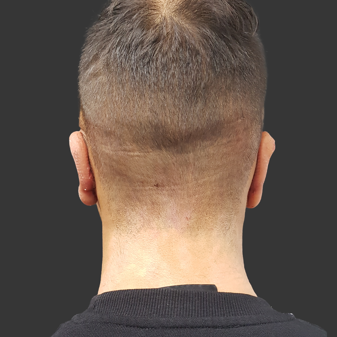 Estetica e Sorriso - Otoplasty After