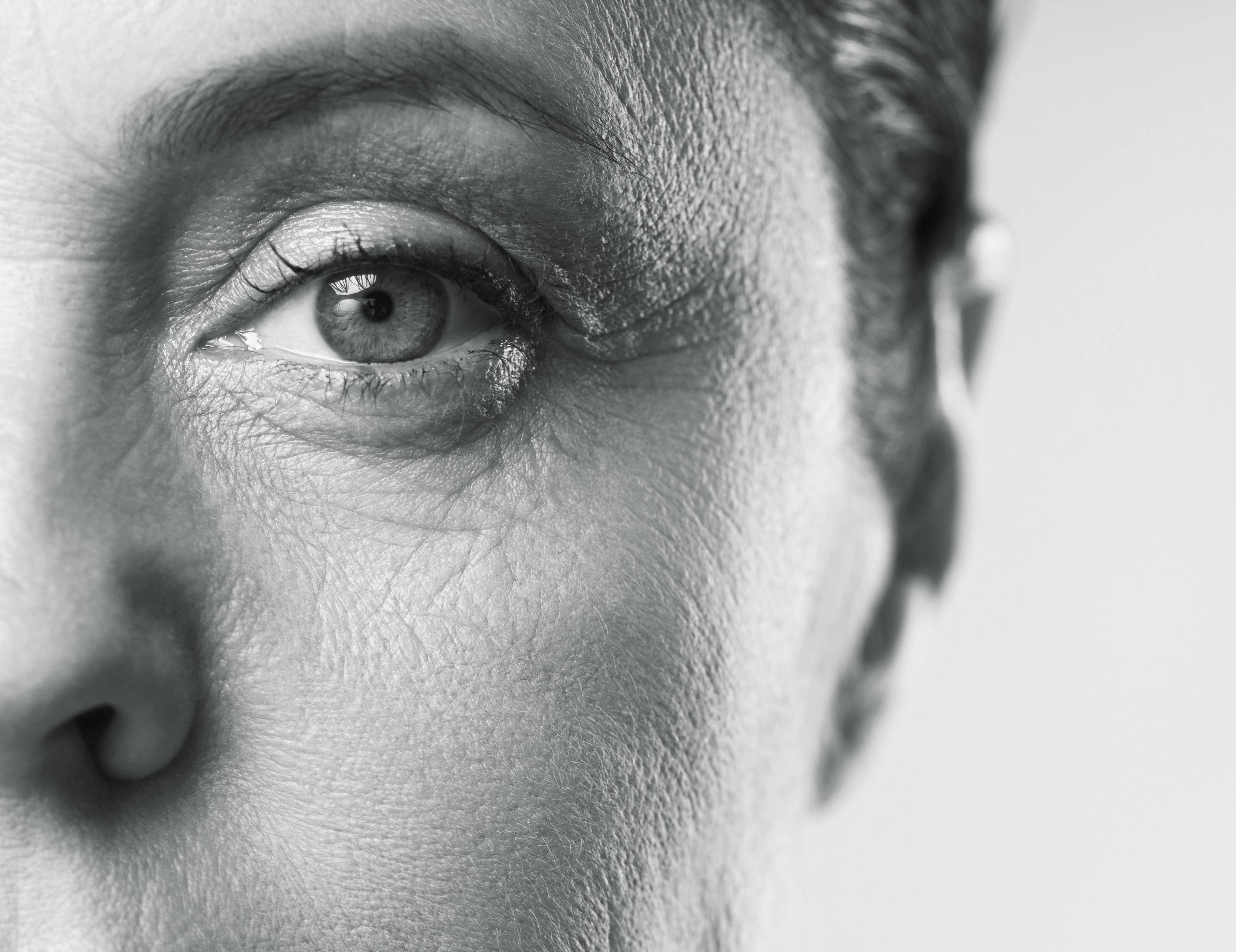 Estetica e Sorriso - Upper Blepharoplasty Before