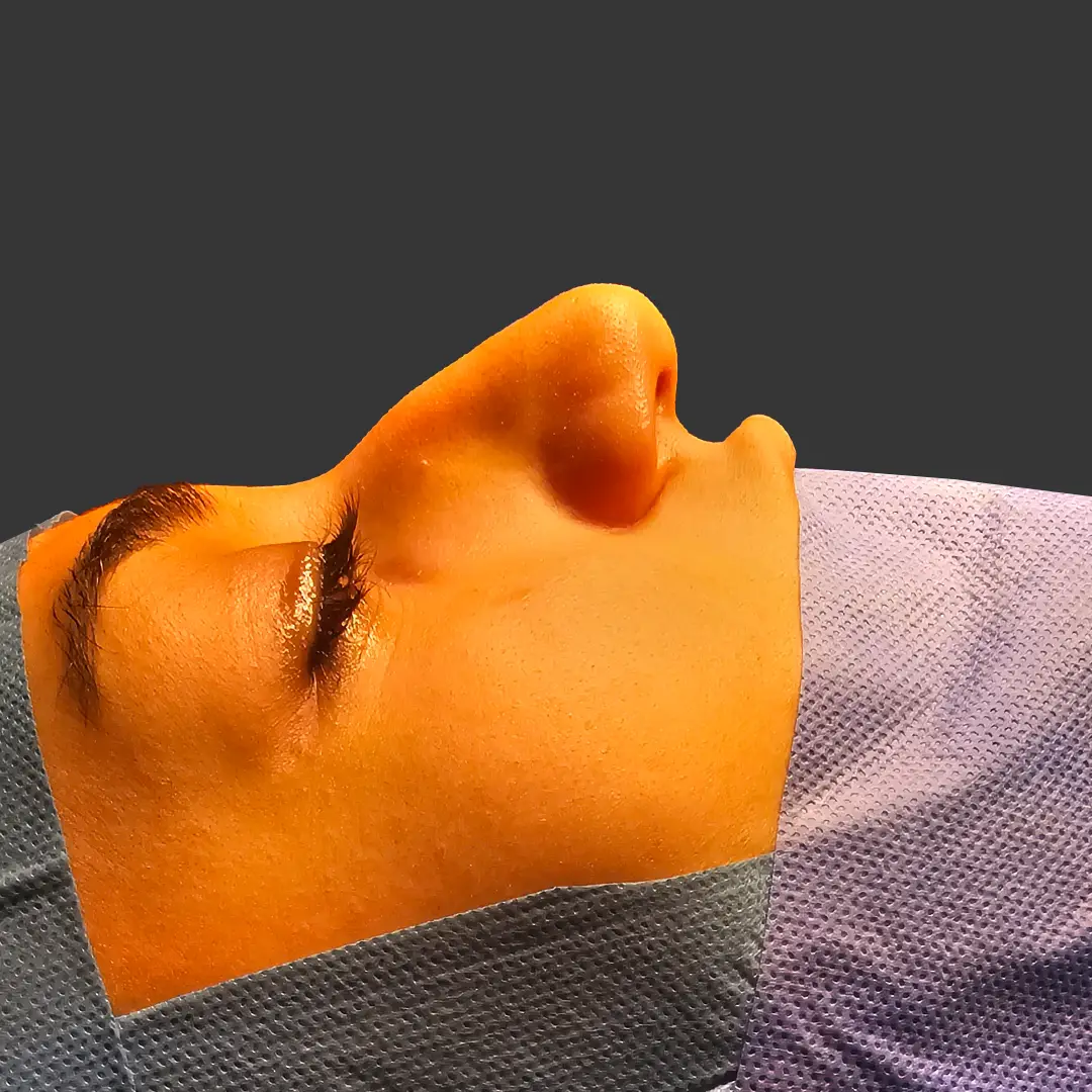 Estetica e Sorriso - Rhinoplasty Before