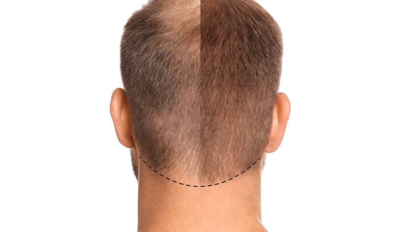 Trapianto di capelli - Estetica e Sorriso