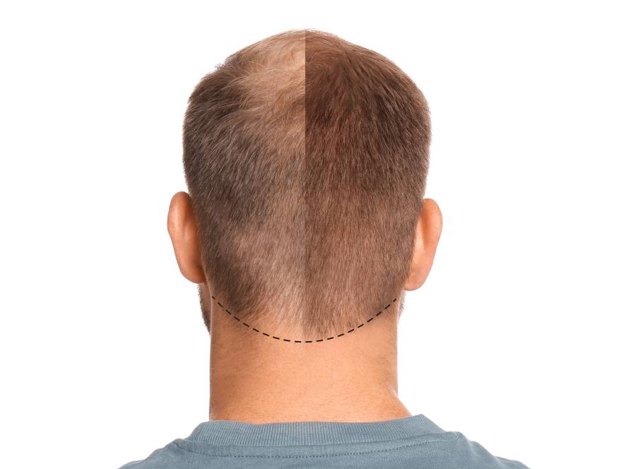 Trapianto di capelli - Estetica e Sorriso